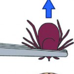 How to remove a tick. Graphics courtesy of the Centers for Disease Control.